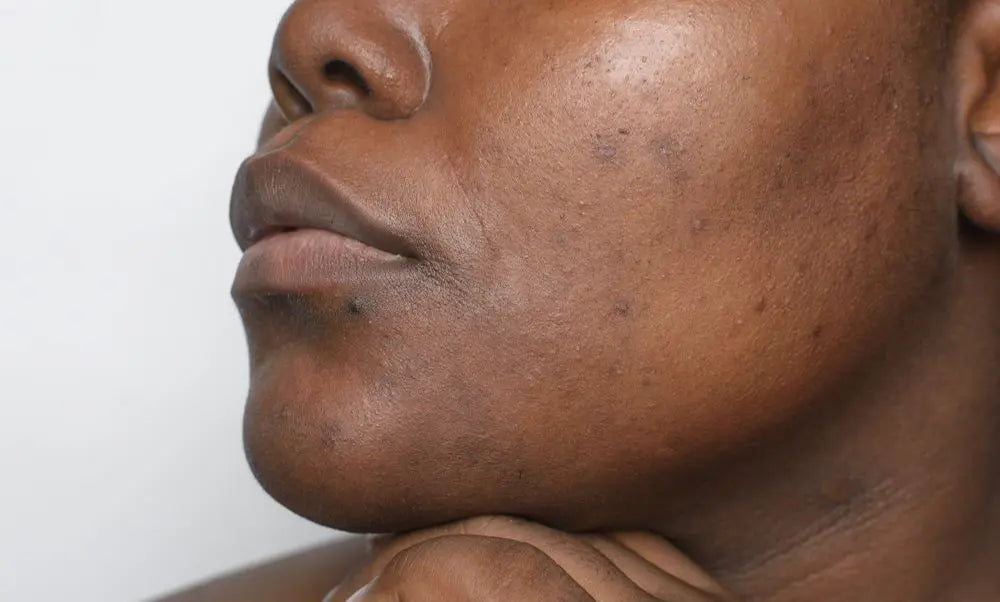 Understanding The Different Types Of Hyperpigmentation